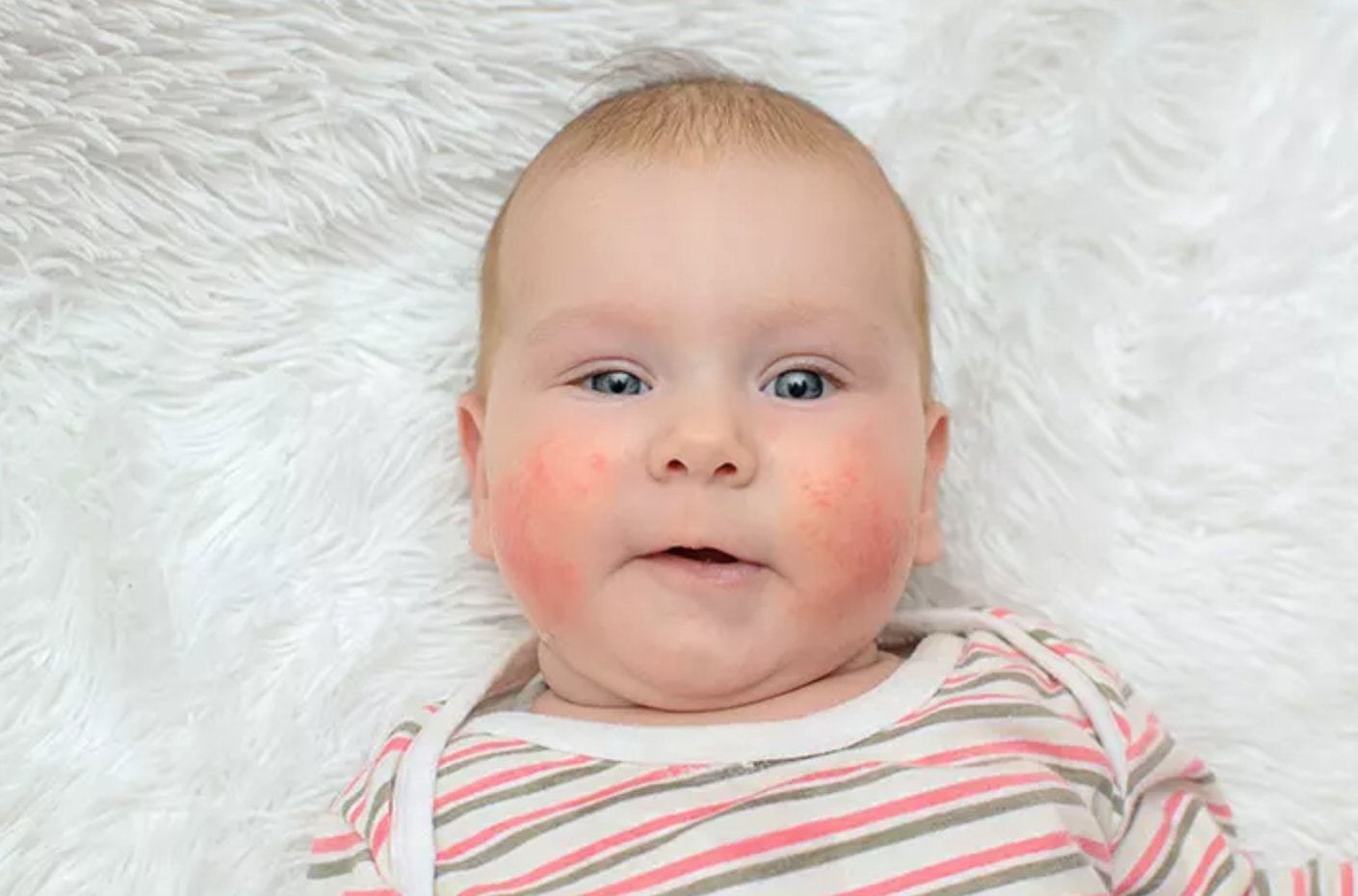 Ilustrasi Alergi Pada Bayi